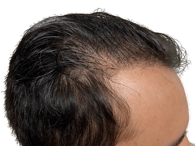 Receding hairline on Asian man. Hair thinning example. Potential hair transplant candidate. Hair restoration options.