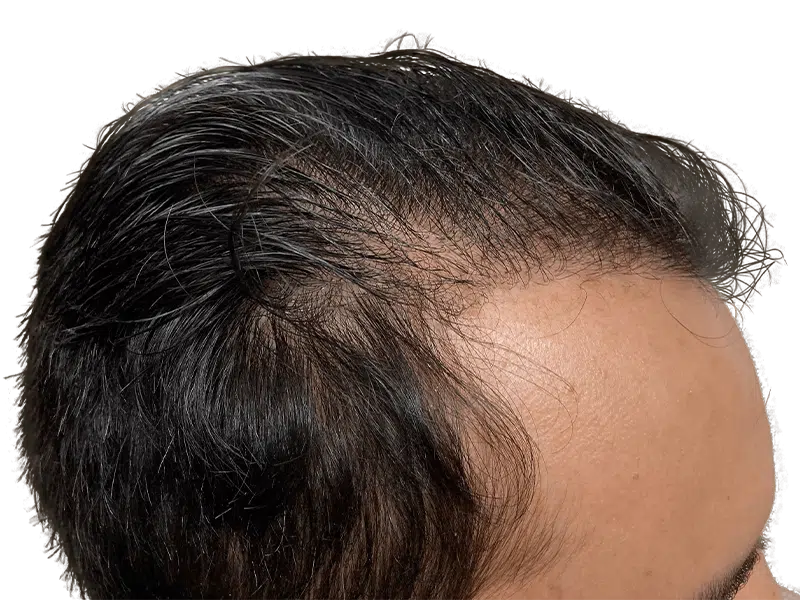 Receding hairline on Asian man. Hair thinning example. Potential hair transplant candidate. Hair restoration options.