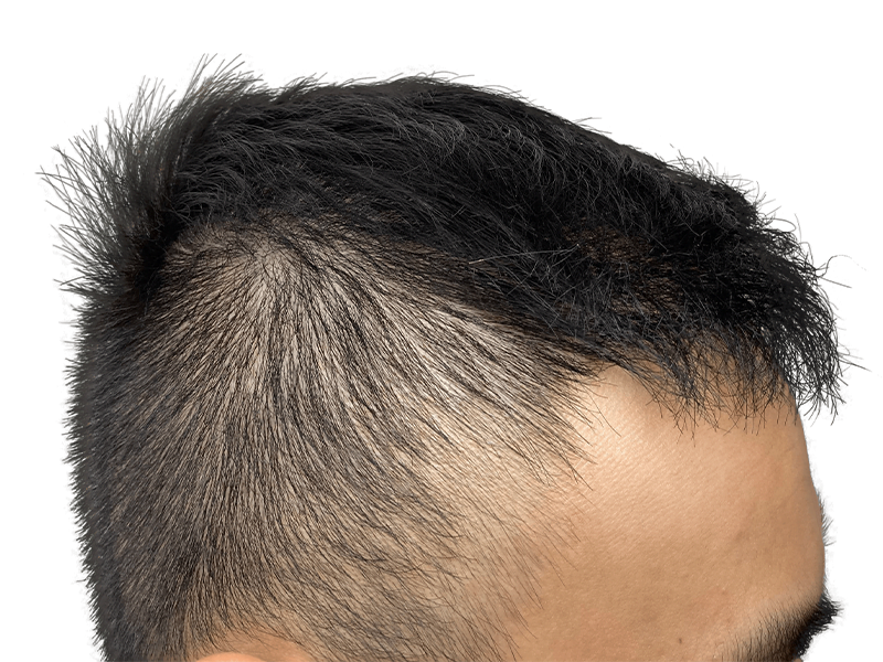 Receding hairline on Asian man. Hair thinning indicates need for hair restoration or transplant consultation.
