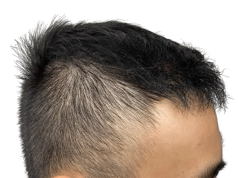 Receding hairline on Asian man. Hair thinning indicates need for hair restoration or transplant consultation.