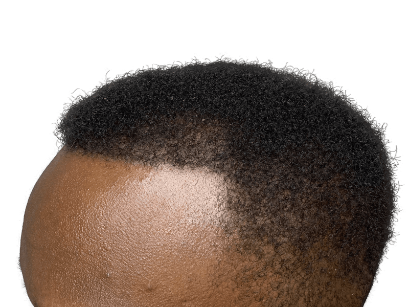 Dense, natural black hair. Potential hair restoration results. No visible transplant evidence. Forehead and hairline focus.