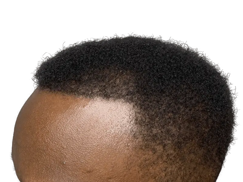 Dense, natural black hair. Potential hair restoration results. No visible transplant evidence. Forehead and hairline focus.