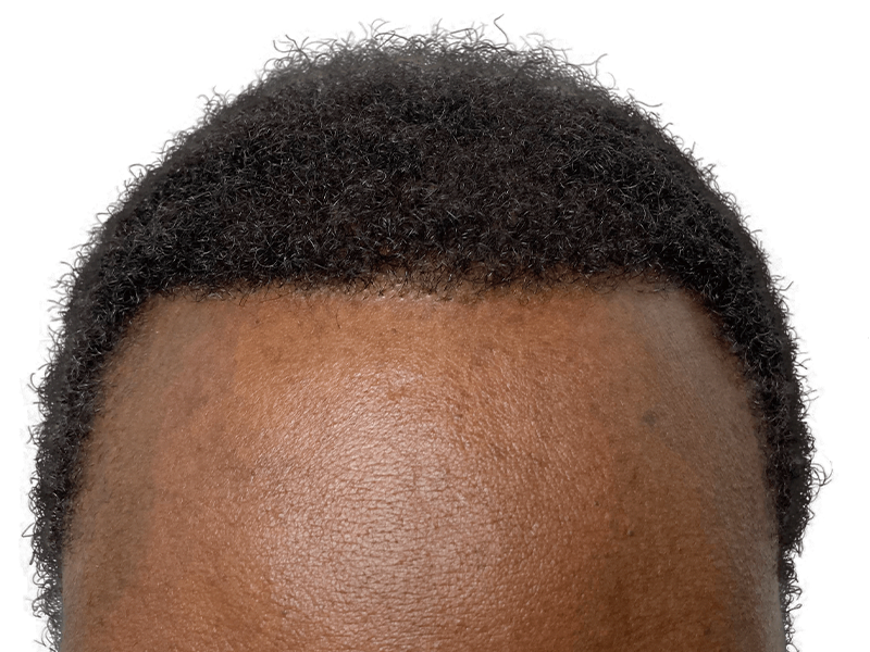African American male hairline. Potential hair restoration candidate. Before hair transplant evaluation.