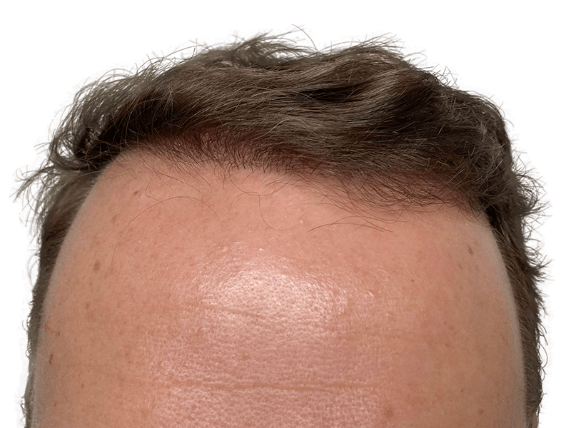 Hair transplant result: Natural hairline restoration. Before & after hair density shown. Brown, wavy hair.