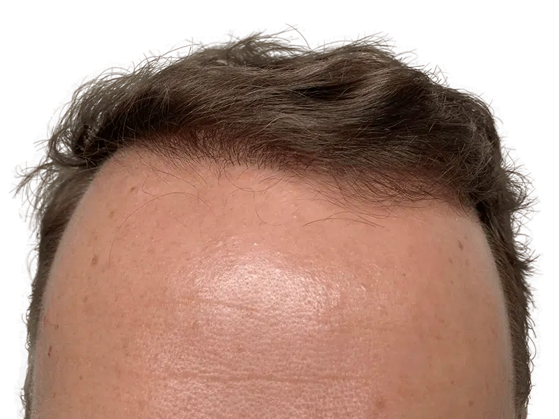 Hair transplant result: Natural hairline restoration. Before & after hair density shown. Brown, wavy hair.