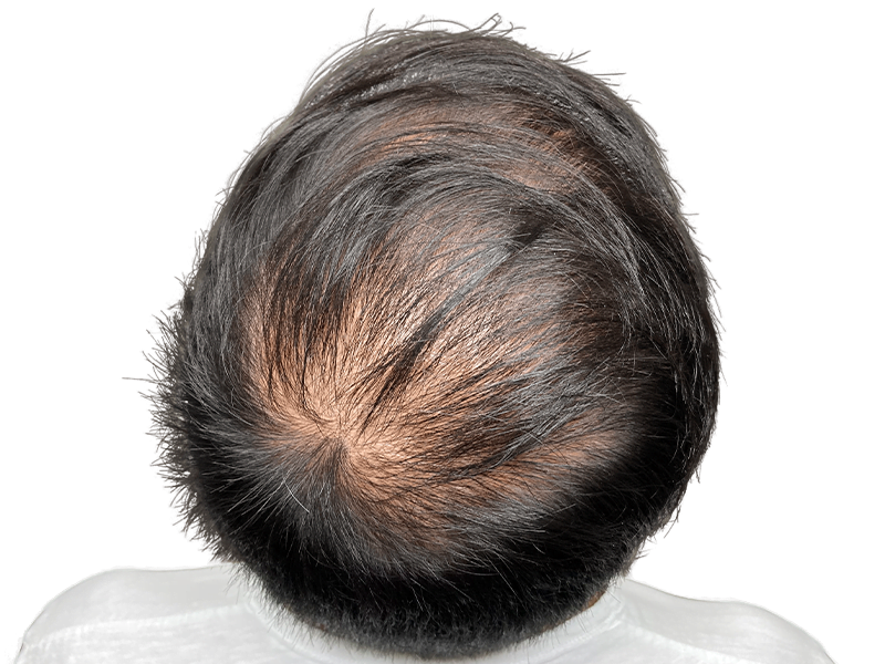 Thinning hair on scalp. Hair loss indicator. Consider hair restoration or hair transplant options for fuller hair.