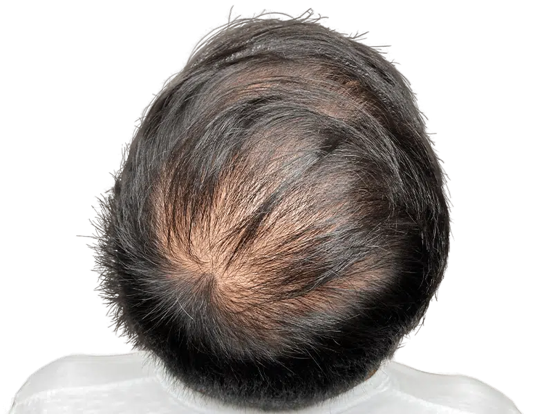 Thinning hair on scalp. Hair loss indicator. Consider hair restoration or hair transplant options for fuller hair.