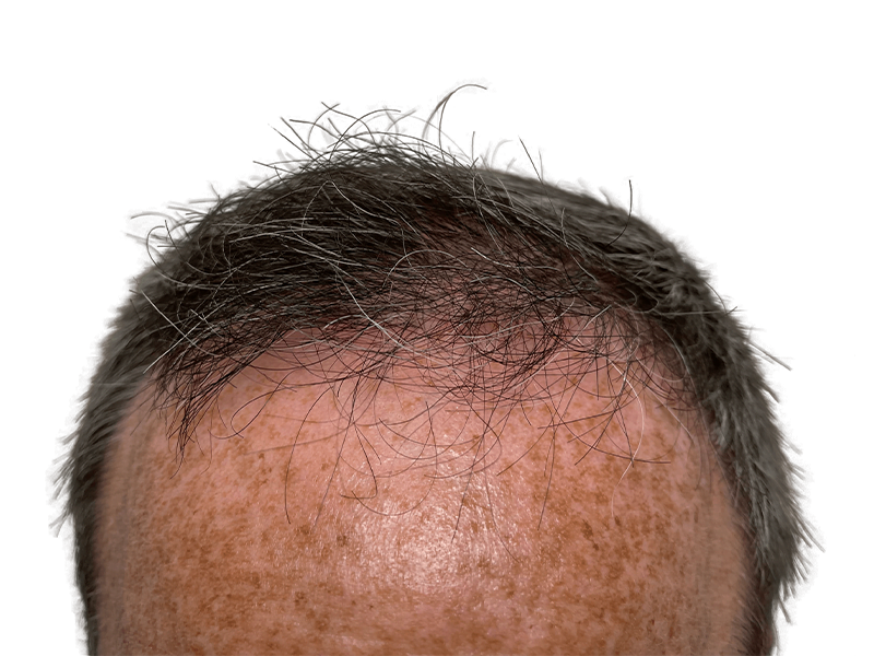 Before hair transplant: Receding hairline on fair skin. Hair restoration candidate. Thinning gray and brown hair.
