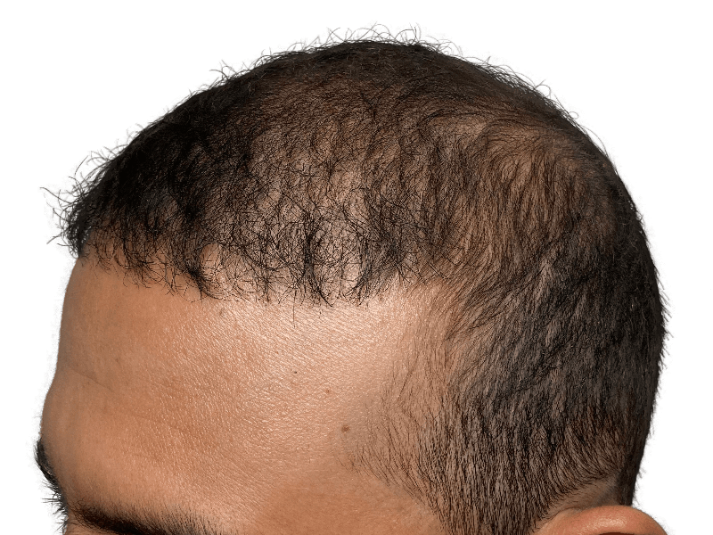 Man's thinning hairline. Possible hair transplant before photo. Dark brown hair, Caucasian. Hair restoration option.