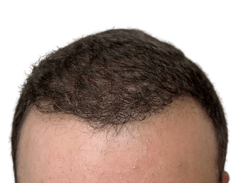 Receding hairline. Consider hair transplant options for fuller hair. Hair restoration before/after potential.