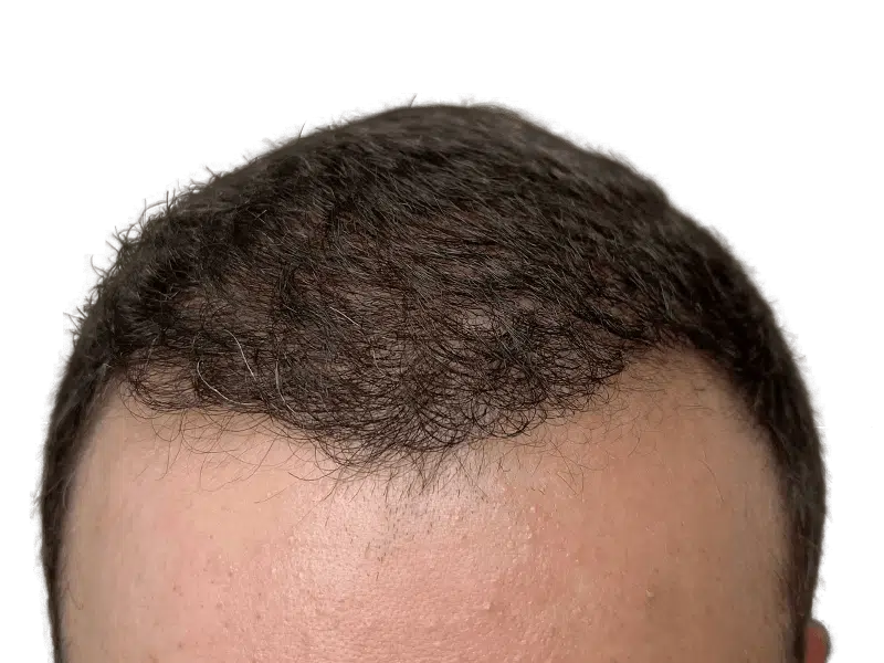Receding hairline. Consider hair transplant options for fuller hair. Hair restoration before/after potential.