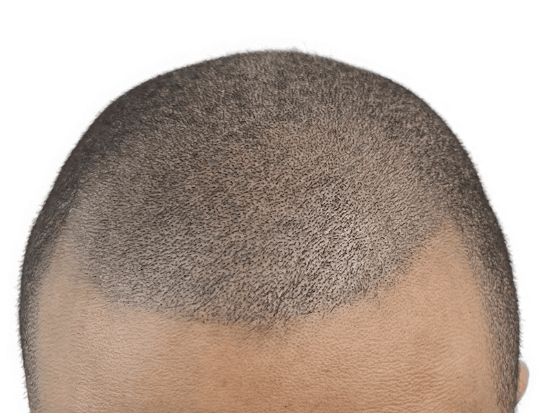 Close-up of thinning hair. Possible hair transplant result? Graying, short hair. Hair restoration consideration.
