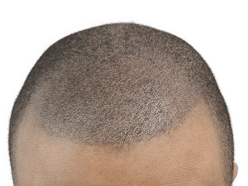 Close-up of thinning hair. Possible hair transplant result? Graying, short hair. Hair restoration consideration.