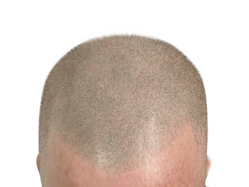 Hair transplant result: Close-up of restored hairline. Even hair density, natural look. Hair restoration success.