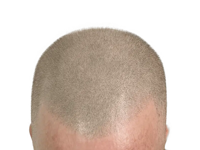 Hair transplant result: Close-up of restored hairline. Even hair density, natural look. Hair restoration success.