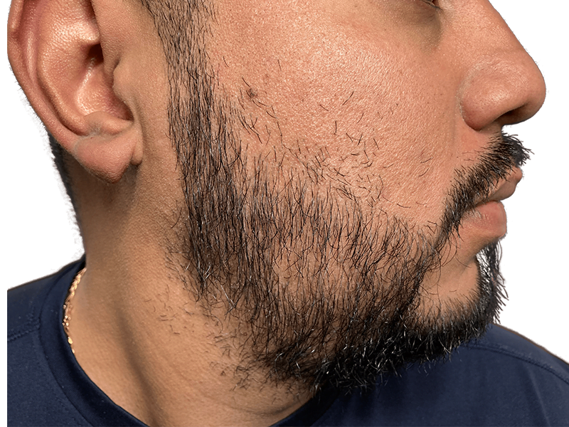 Beard hair transplant result: Hispanic man with fuller beard after hair restoration. Sparse beard correction.