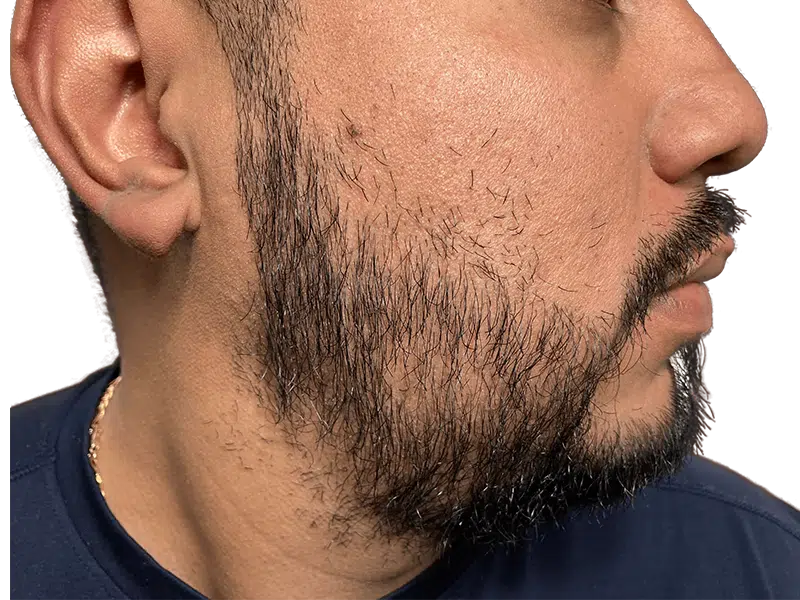 Beard hair transplant result: Hispanic man with fuller beard after hair restoration. Sparse beard correction.