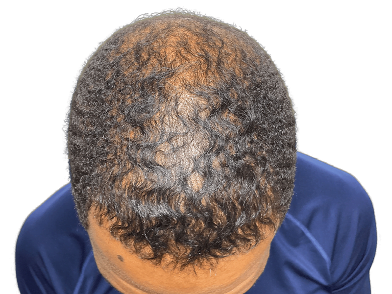 Thinning hair on Black male crown. Potential hair transplant candidate. Consult for hair restoration options & before/after results.