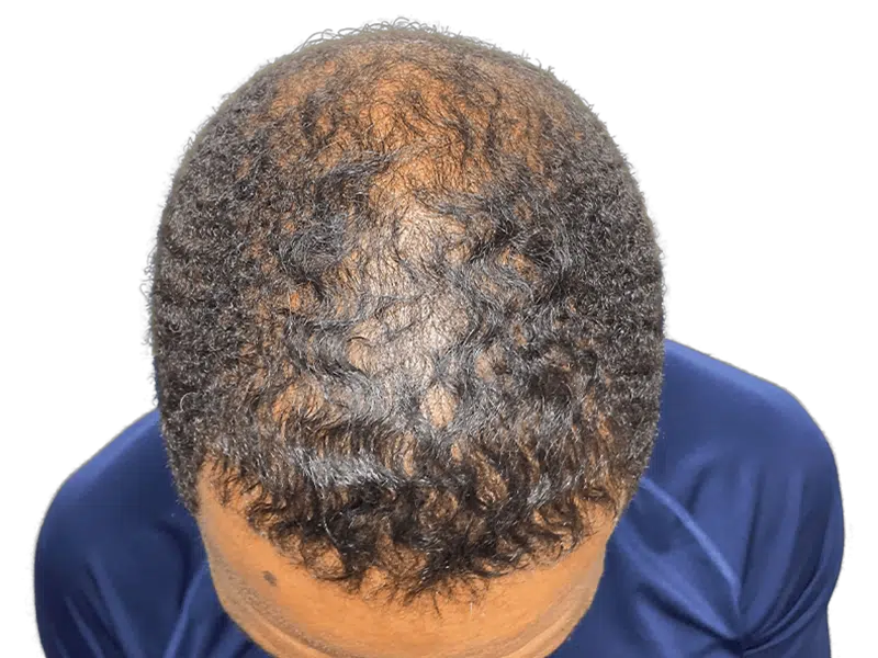 Thinning hair on Black male crown. Potential hair transplant candidate. Consult for hair restoration options & before/after results.
