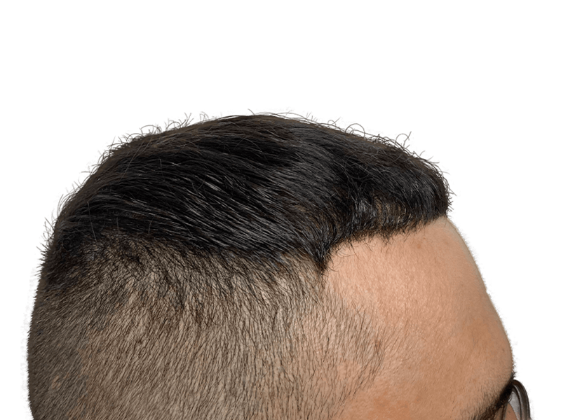 Hair transplant result: Improved hairline and density. Before & after hair restoration example. Dark hair, light skin.