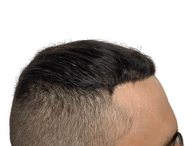 Hair transplant result: Improved hairline and density. Before & after hair restoration example. Dark hair, light skin.