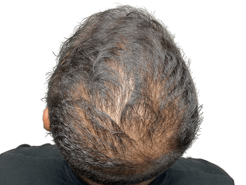 Thinning hair & receding hairline. Scalp visible. Hair restoration or transplant consultation recommended. Before treatment.