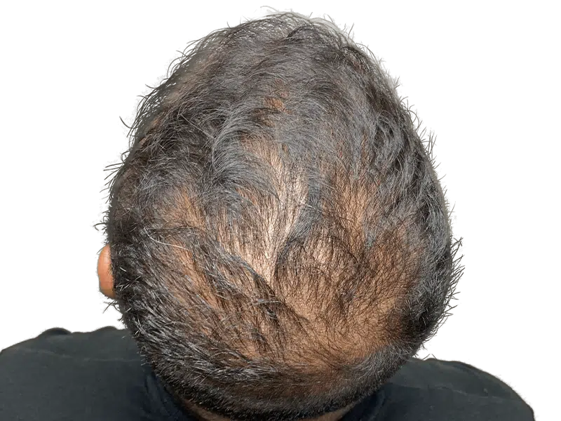 Thinning hair & receding hairline. Scalp visible. Hair restoration or transplant consultation recommended. Before treatment.