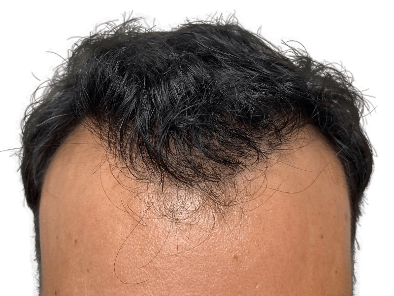 Hairline close-up. Possible hair transplant result. Dark hair, thinning at temples. Hair restoration assessment.