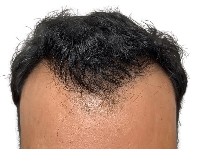Hairline close-up. Possible hair transplant result. Dark hair, thinning at temples. Hair restoration assessment.