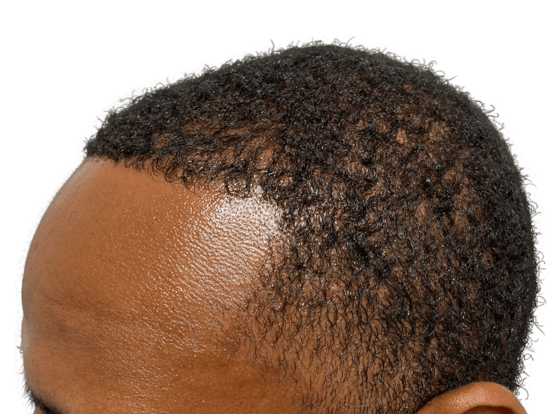 Hair restoration result: African American man's hairline after potential hair transplant. Improved density, dark curly hair.