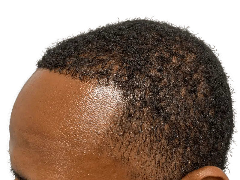 Hair restoration result: African American man's hairline after potential hair transplant. Improved density, dark curly hair.