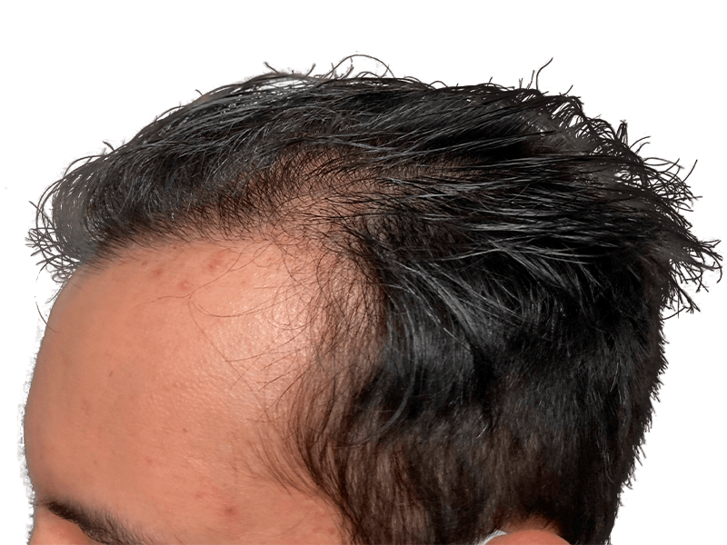 Receding hairline. Hair thinning. Possible hair transplant candidate. Hair restoration before. Dark hair, wet look.