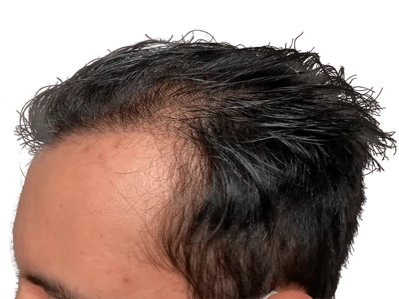 Receding hairline. Hair thinning. Possible hair transplant candidate. Hair restoration before. Dark hair, wet look.