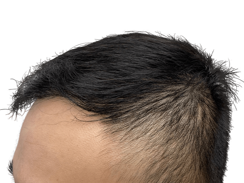 Thinning hairline on Asian man. Potential hair loss candidate. Consider hair restoration or transplant options.