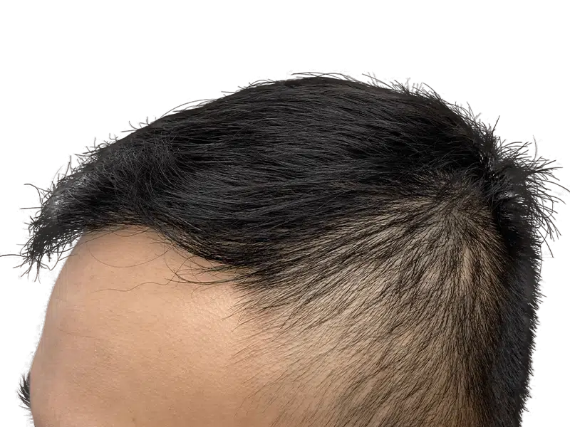 Thinning hairline on Asian man. Potential hair loss candidate. Consider hair restoration or transplant options.