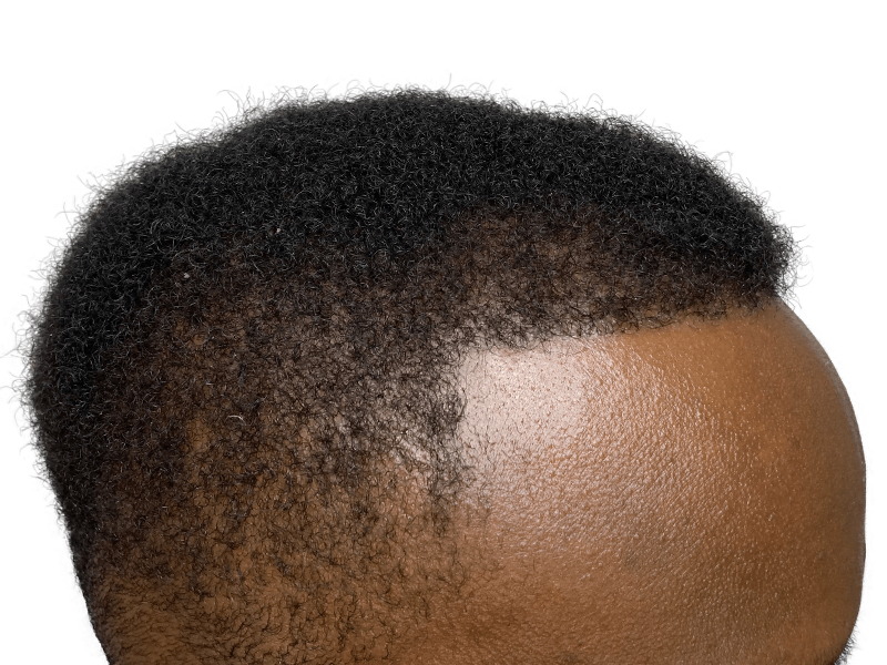 African American man's hairline. Potential hair restoration candidate. No visible hair transplant work.