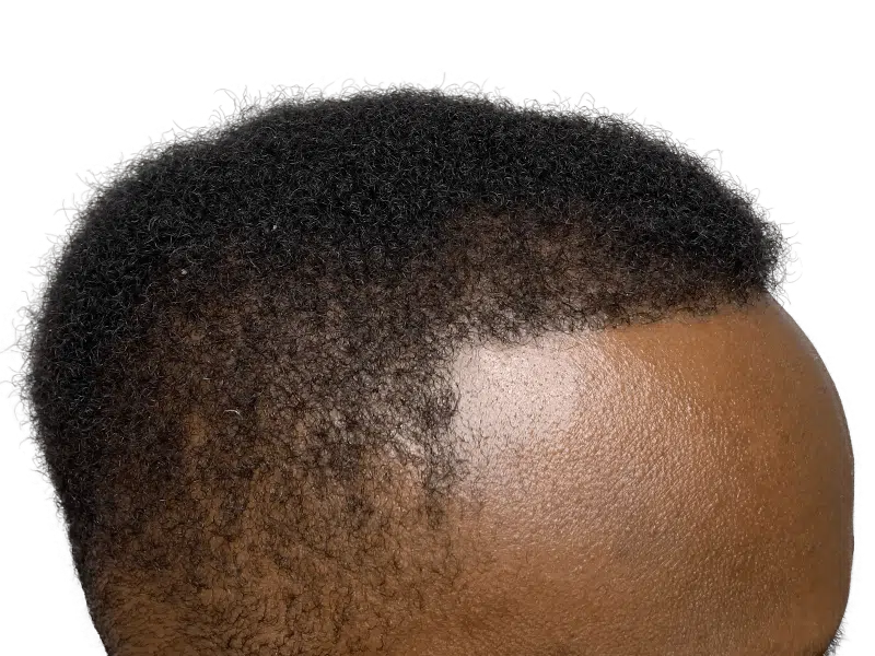 African American man's hairline. Potential hair restoration candidate. No visible hair transplant work.