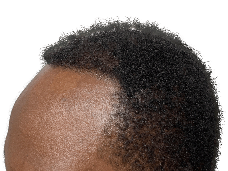 Hair transplant result: Dense, textured hair growth on dark skin. Hair restoration success. Before & after available.