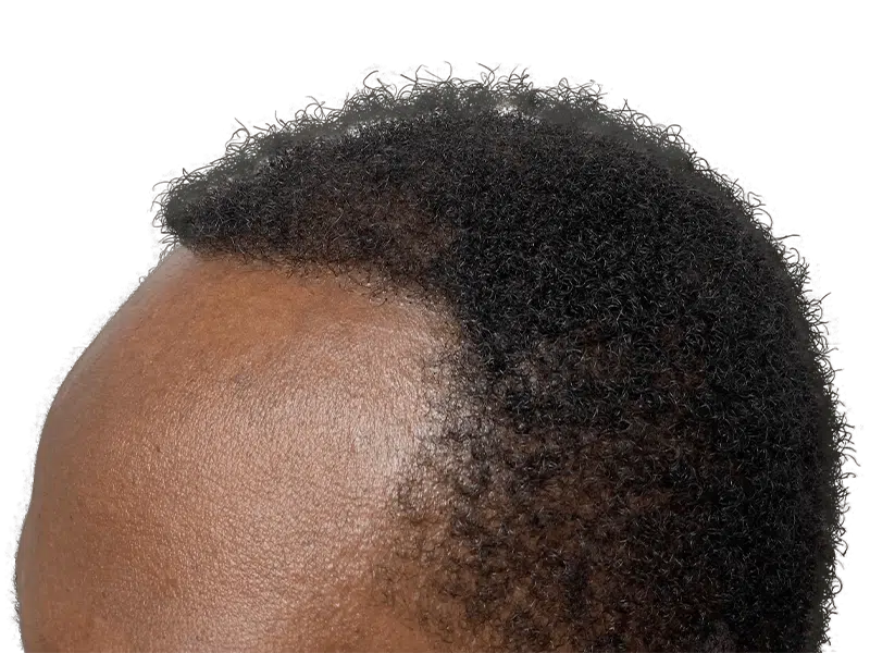 Hair transplant result: Dense, textured hair growth on dark skin. Hair restoration success. Before & after available.