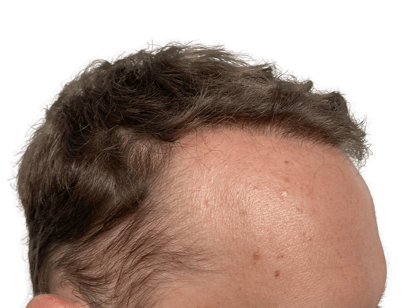 Hair transplant result: Man's fuller, natural hairline. Before & after hair restoration example. Dark brown hair.