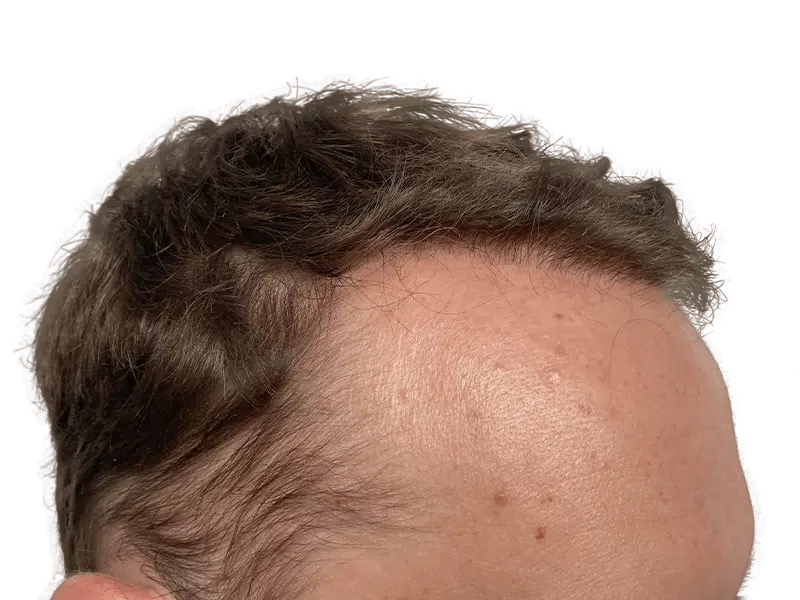 Hair transplant result: Man's fuller, natural hairline. Before & after hair restoration example. Dark brown hair.