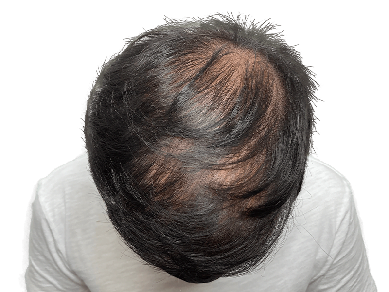 Hair thinning on crown. Possible hair loss. Consider hair restoration or transplant options for fuller hair.