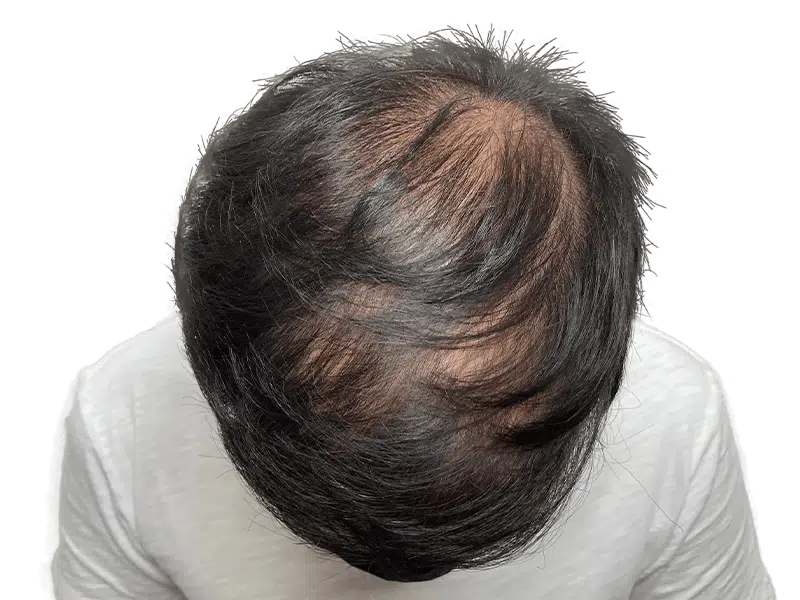 Hair thinning on crown. Possible hair loss. Consider hair restoration or transplant options for fuller hair.