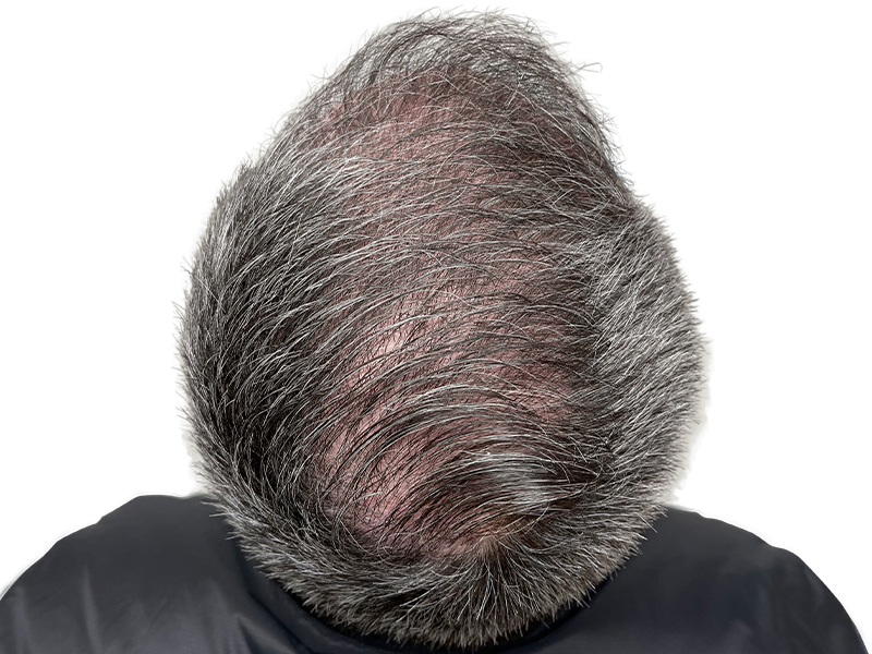 Thinning gray hair at crown. Potential hair loss candidate. Consider hair restoration options for fuller hair.