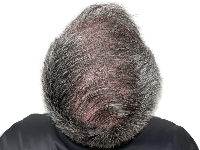 Thinning gray hair at crown. Potential hair loss candidate. Consider hair restoration options for fuller hair.