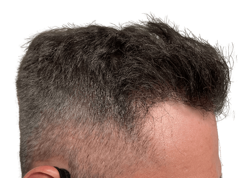 Hair transplant result: Man's hairline showing improved density after restoration. Before/after visible at temples.