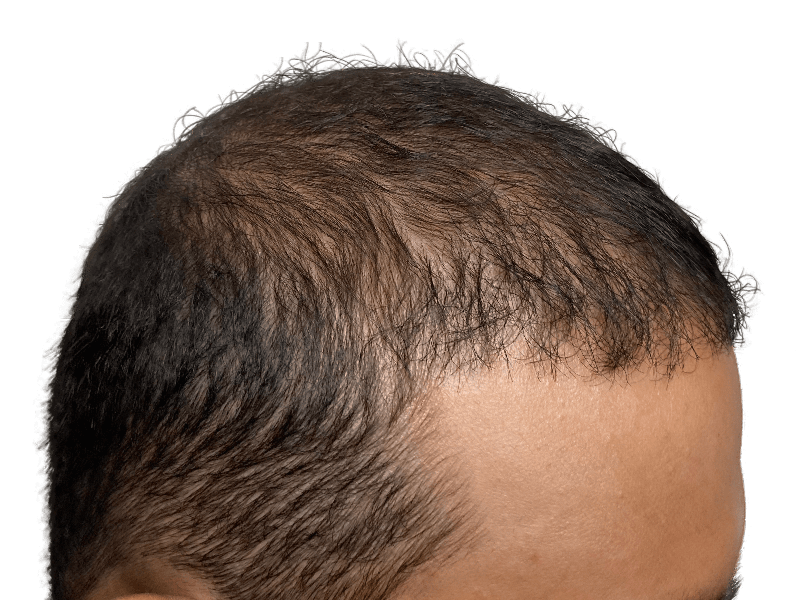 Receding hairline. Hair loss example. Consider hair restoration options like hair transplants for improved density.