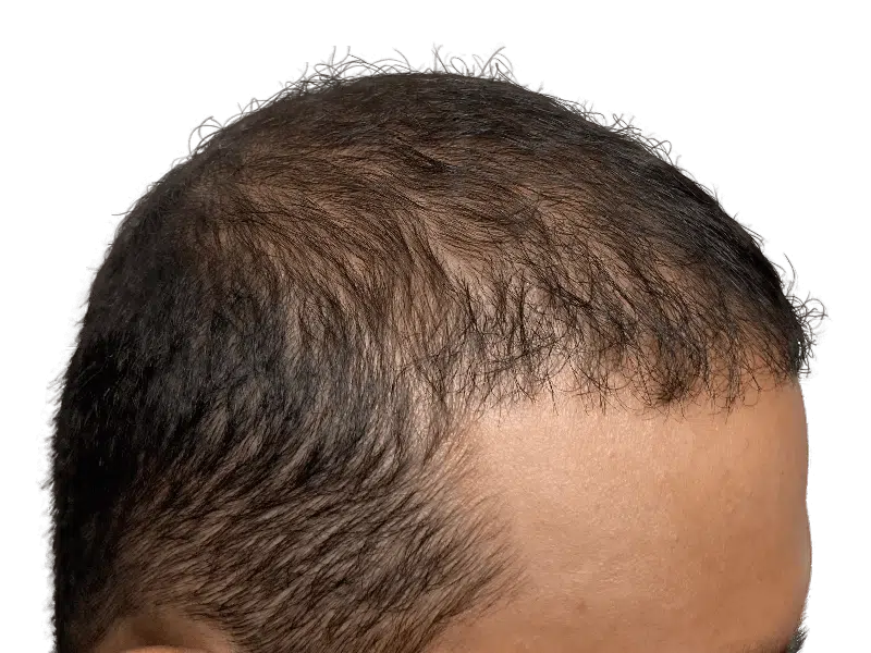 Receding hairline. Hair loss example. Consider hair restoration options like hair transplants for improved density.