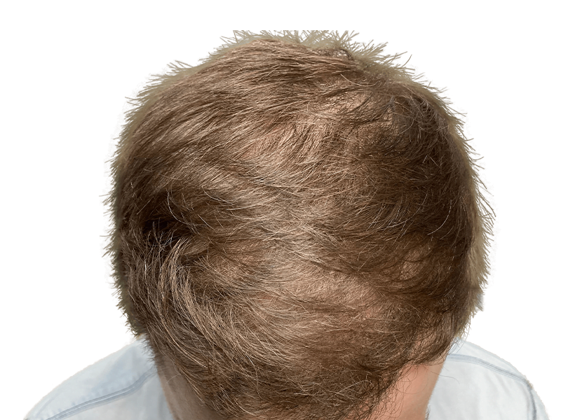 Thinning light brown hair at crown & temples. Potential hair loss. Hair restoration or transplant consultation recommended.