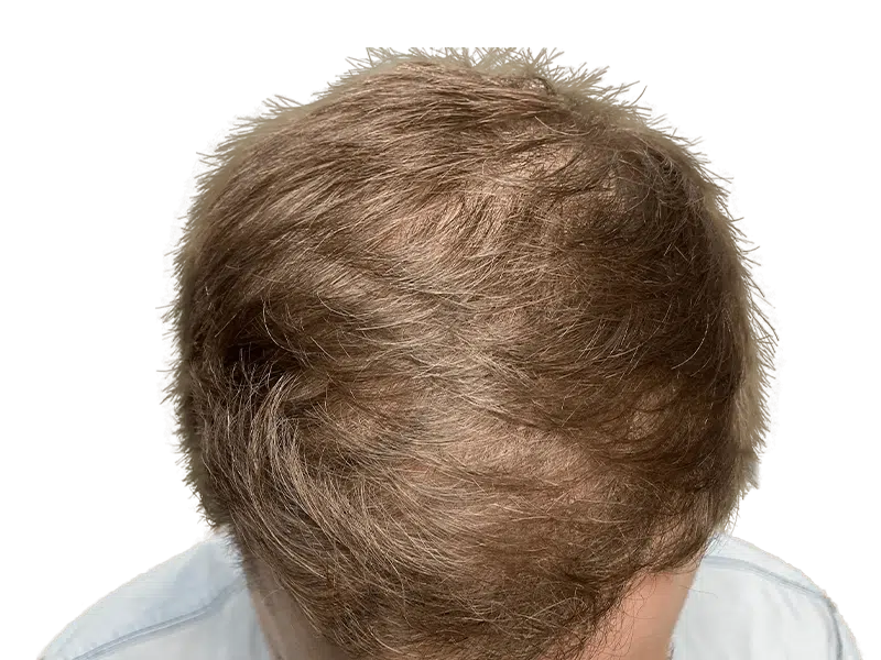 Thinning light brown hair at crown & temples. Potential hair loss. Hair restoration or transplant consultation recommended.
